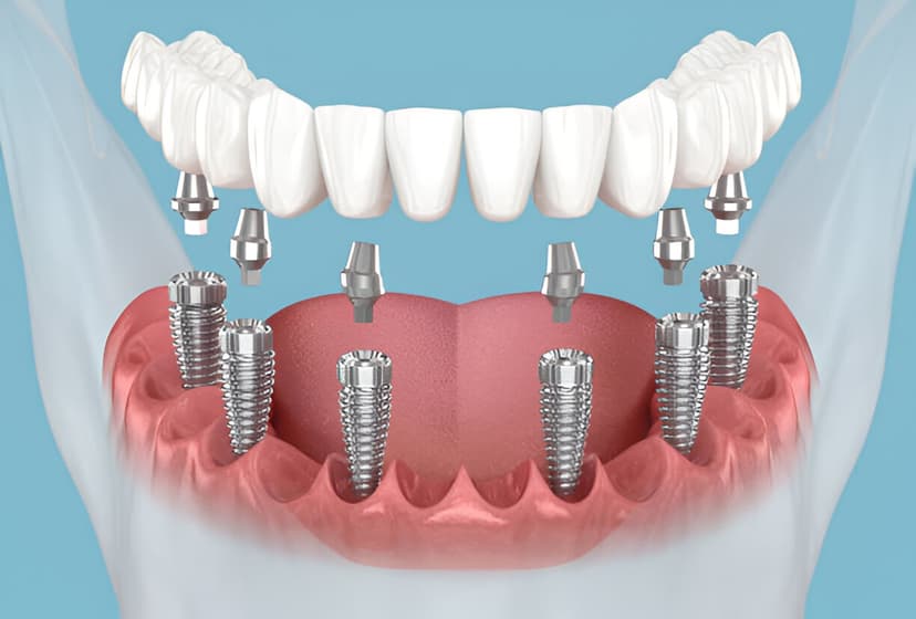Implantes - Clínica Dental Zegarra